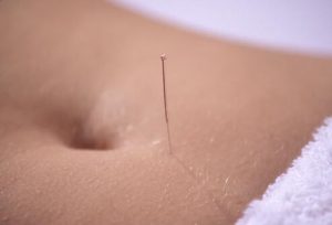 acupuncture-s14-photo-of-acupuncture-on-stomach