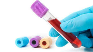 هل يجب الصيام قبل تحليل الدم؟
