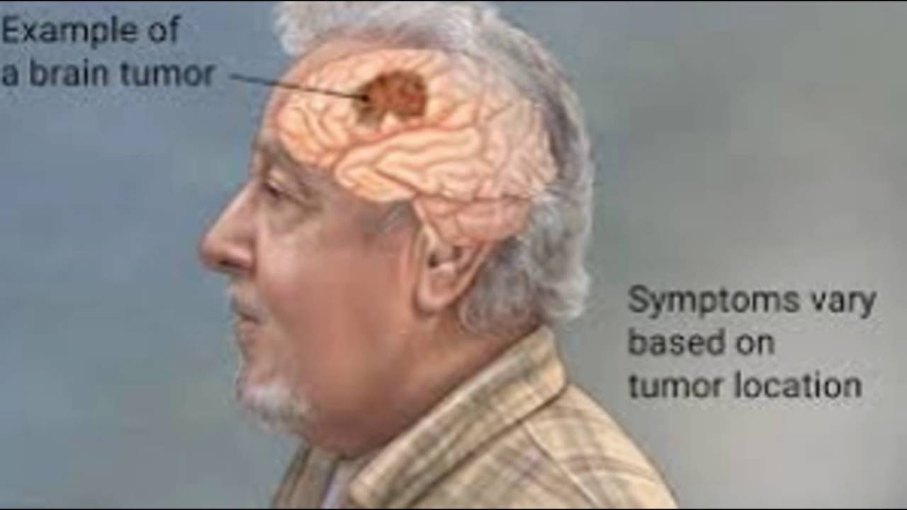 أعراض سرطان المخ