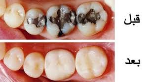 اضرار تسوس الاسنان وطرق الوقاية