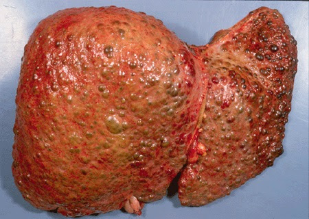 أعراض مرض سرطان الكبد القاتل
