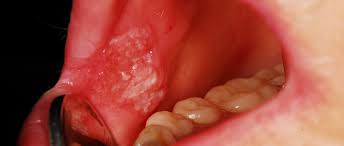 ما هو سرطان الفم وكيف يحدث؟