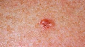 ما هو مرض سرطان الجلد وما هي أنواعه وما المراحل التي يمر بها سرطان الجلد؟